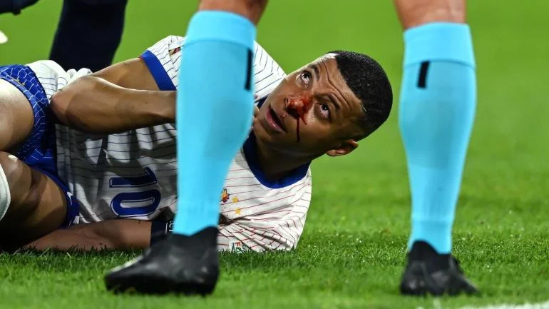 Kylian Mbappe’s Could Miss Euro 2024 Campaign After Suffering Broken Nose Against Austria