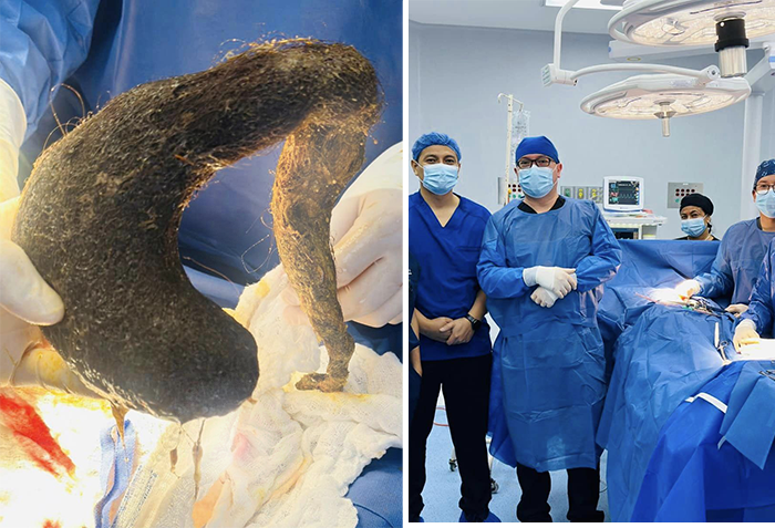 Ecuadorian Doctors Successfully Remove Giant Two Pound 16-inch Hairball from Woman’s Stomach(Photo Inside)