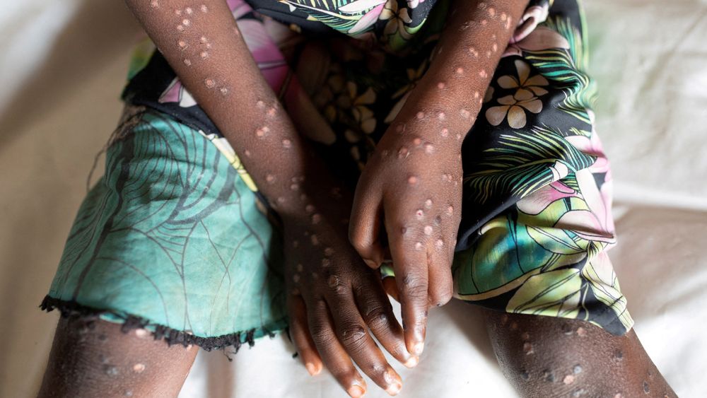 Central African Republic Announces Mpox Outbreak