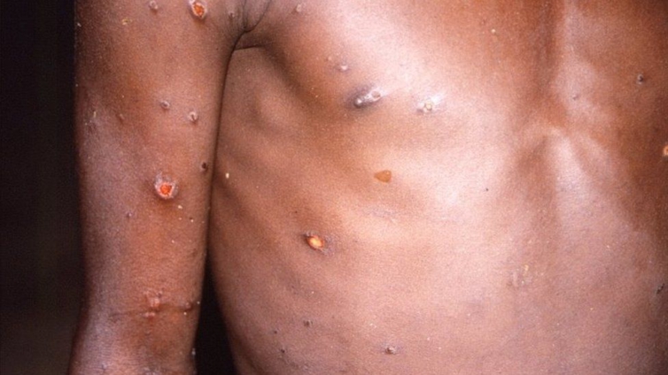 9 Essential Facts About Mpox: Stay Informed and Safe