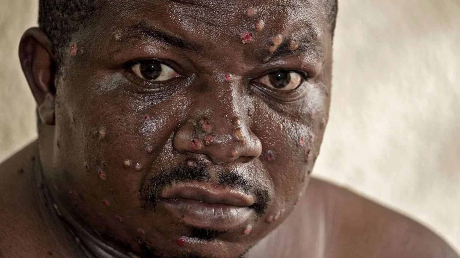 ‘Mpox Made My Throat So Painful I Couldn’t Sleep’: Burundi Patient Describes Symptoms Amid Outbreak