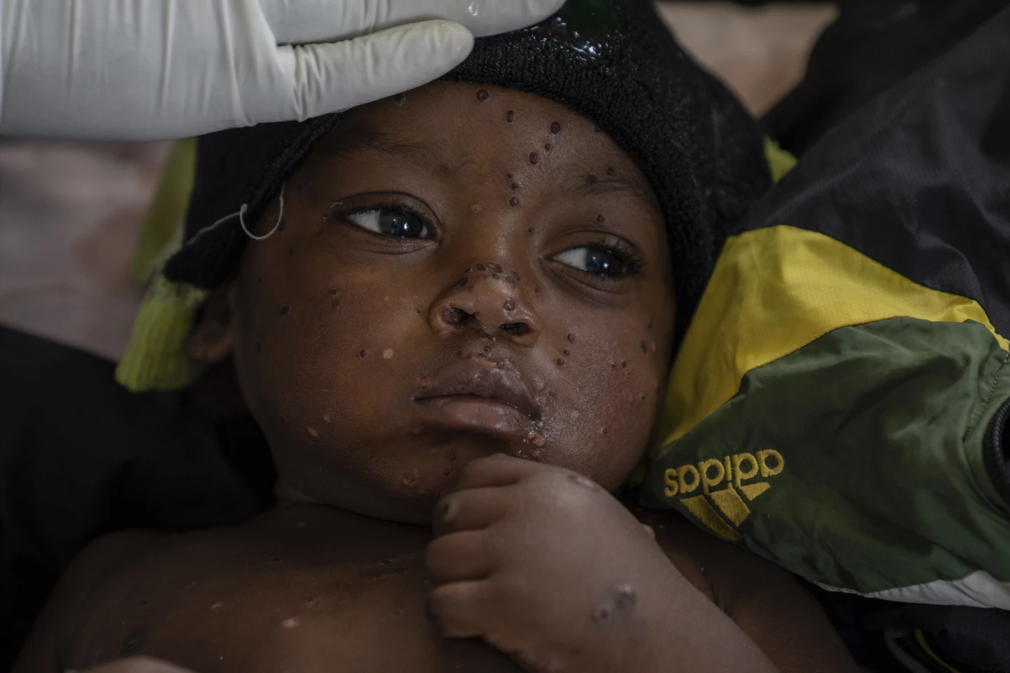 Mpox Outbreak Surges in Congo Gold Mining Town, Straining Resources