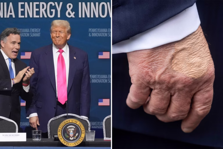 White House Confirms Trump Diagnosed With Chronic Vein Condition Amid Speculation Over Bruising